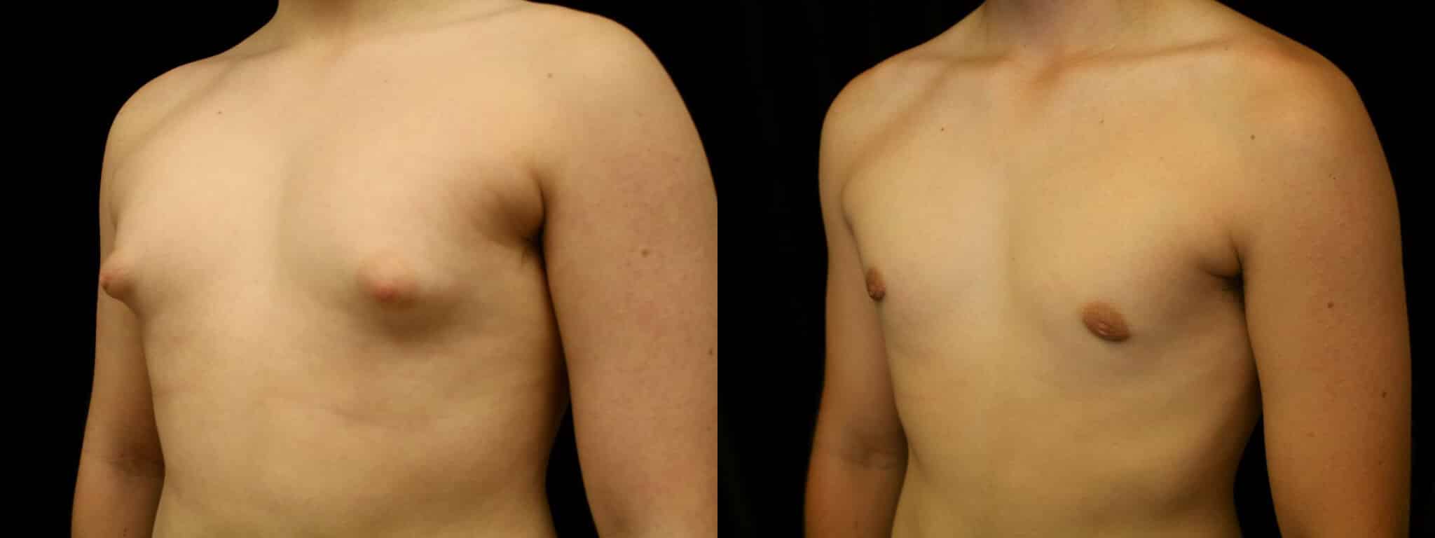 Gynecomastia Patient 12 Before & After Details