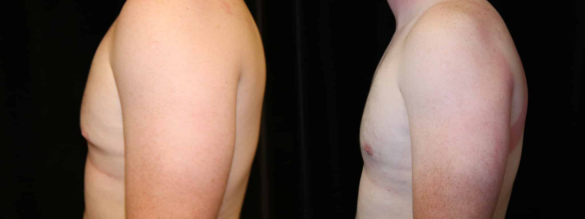 Gynecomastia Patient 17 Before & After Details