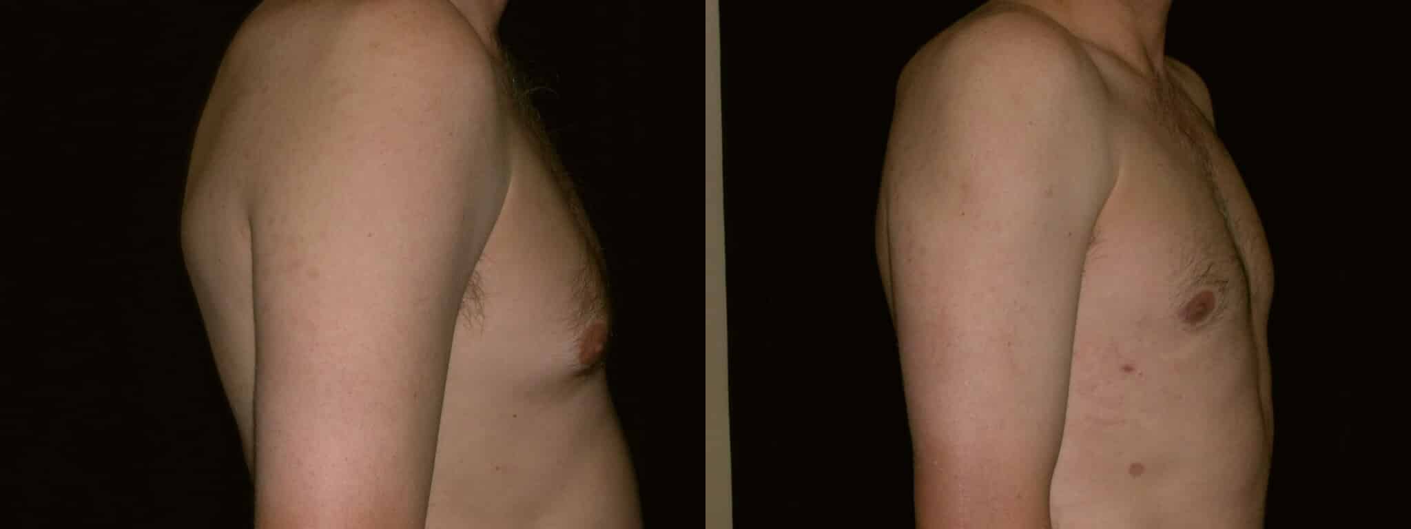 Gynecomastia Patient 20 Before & After