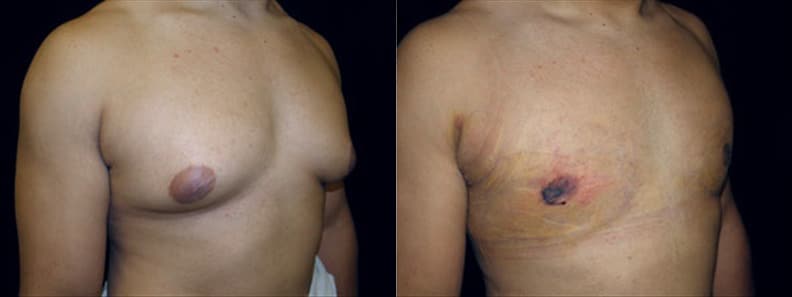 Gynecomastia Patient 21 Before & After Details