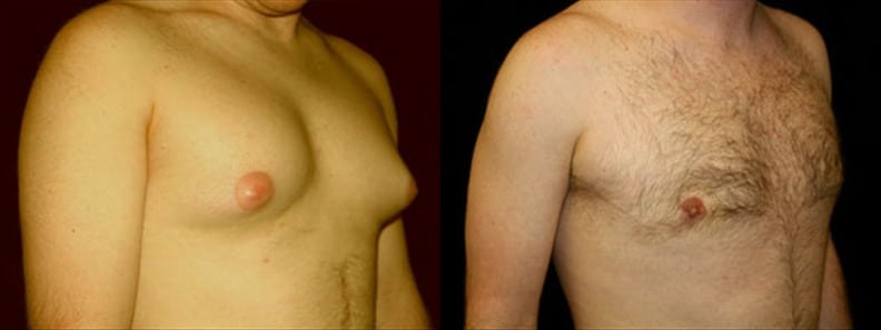 Gynecomastia Patient 16 Before & After Details