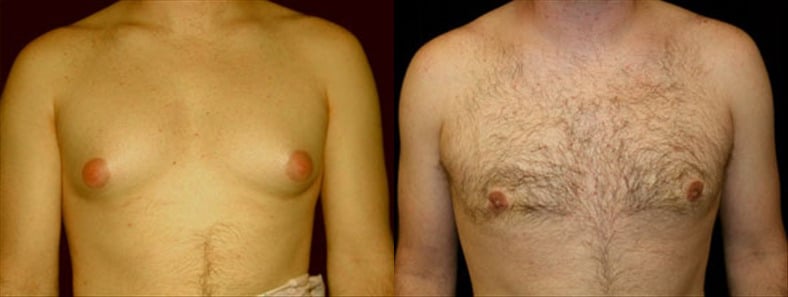 Gynecomastia Patient 16 Before & After