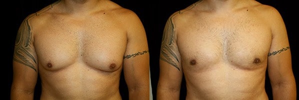 Gynecomastia Patient 12 Before & After