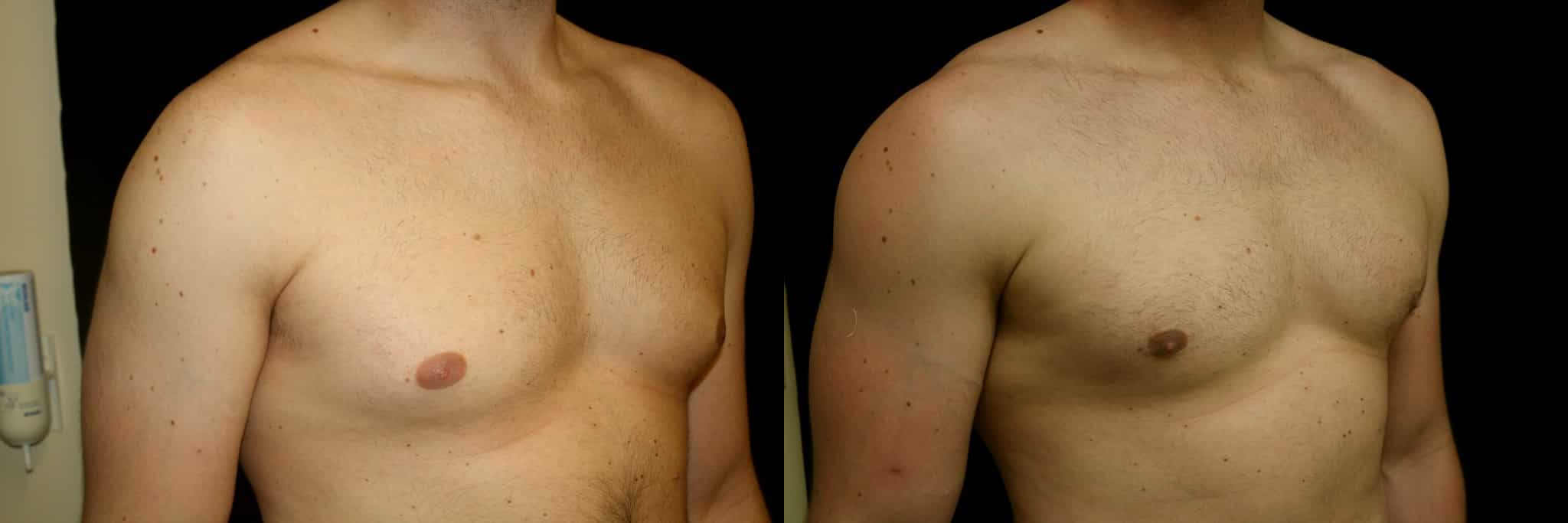 Gynecomastia Patient 8 Before & After Details