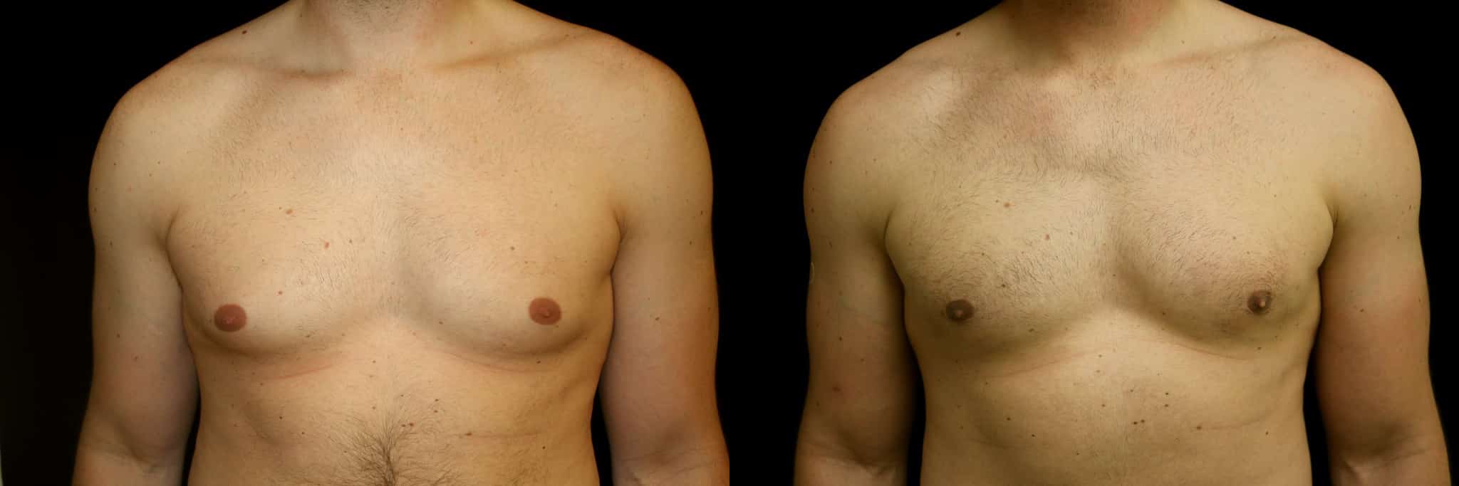 Gynecomastia Patient 8 Before & After