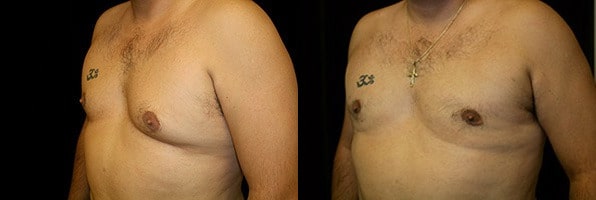 Gynecomastia Patient 12 Before & After Details