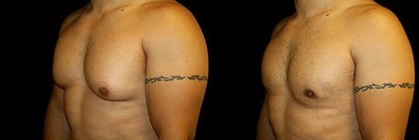 Gynecomastia Patient 12 Before & After Details