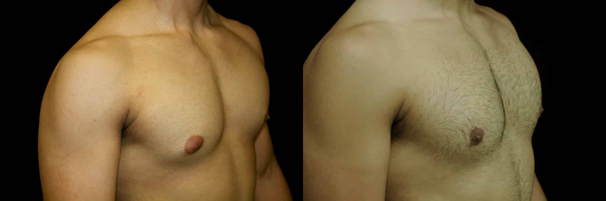 Gynecomastia Patient 13 Before & After Details