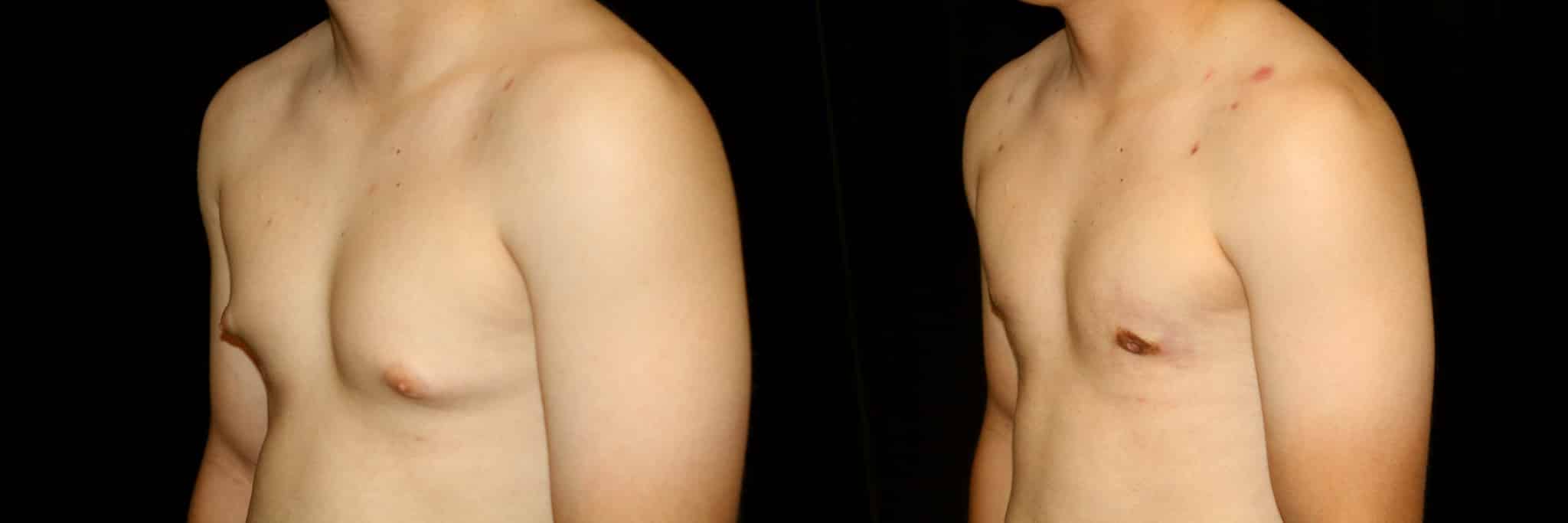 Gynecomastia Patient 20 Before & After Details