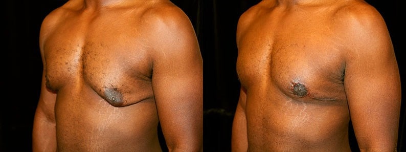 Gynecomastia Patient 17 Before & After Details