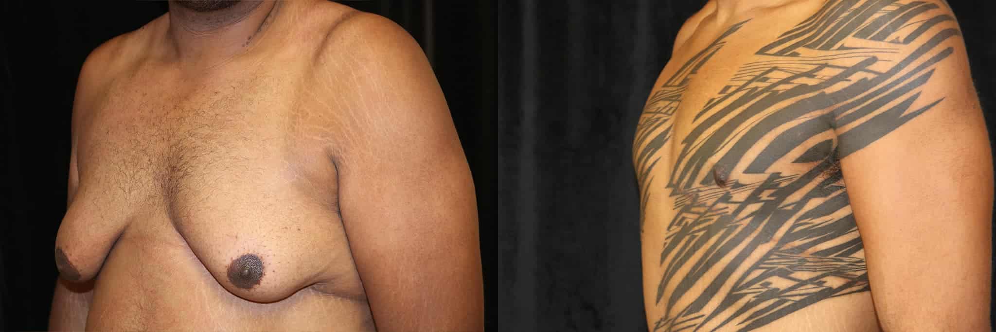 Gynecomastia Patient 11 Before & After Details