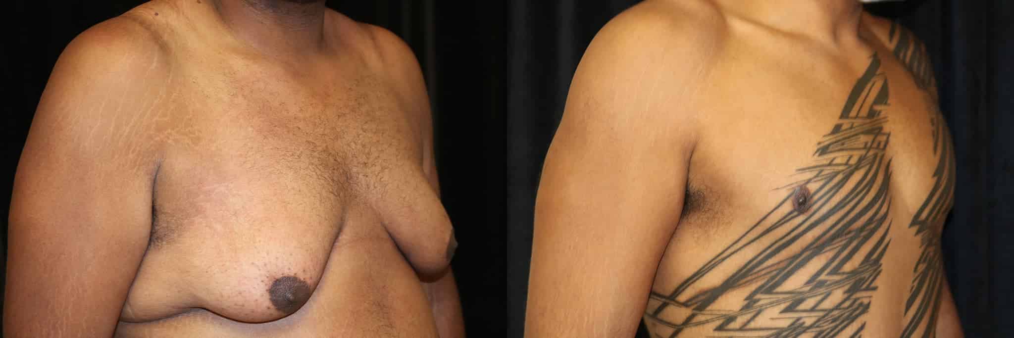 Gynecomastia Patient 11 Before & After Details