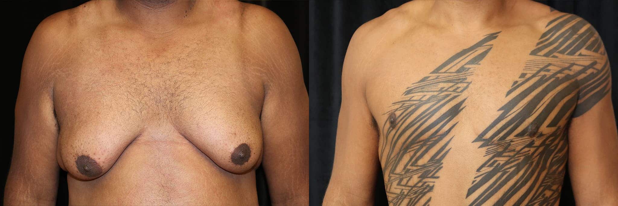 Gynecomastia Patient 11 Before & After