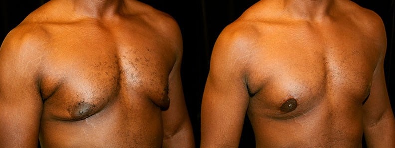 Gynecomastia Patient 17 Before & After Details