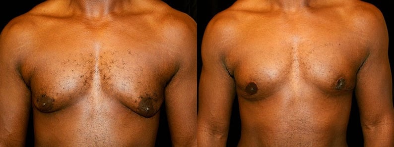 Gynecomastia Patient 17 Before & After