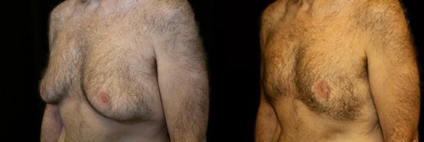 Gynecomastia Patient 19 Before & After Details