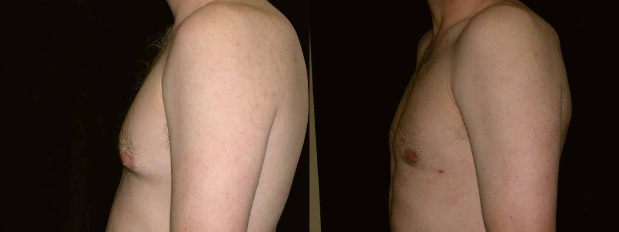 Gynecomastia Patient 20 Before & After Details