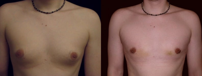 Gynecomastia Patient 4 Before & After