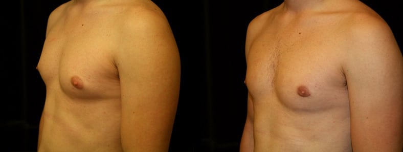 Gynecomastia Patient 4 Before & After Details