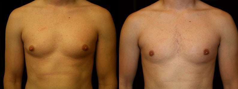 Gynecomastia Patient 4 Before & After