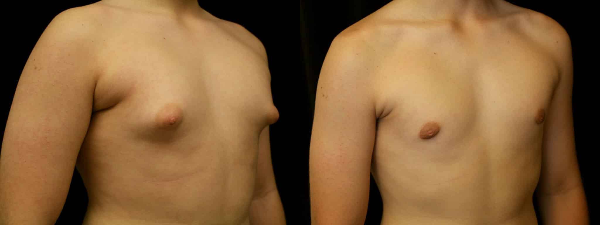 Gynecomastia Patient 12 Before & After Details