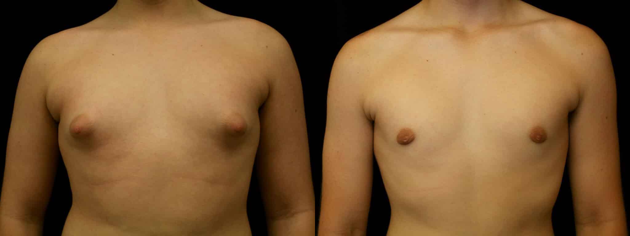 Gynecomastia Patient 12 Before & After