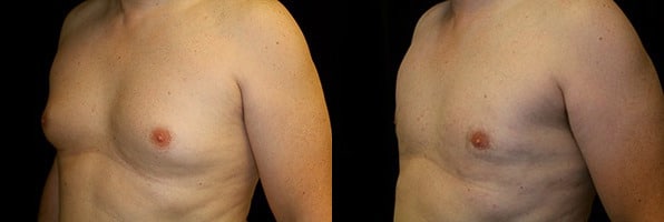 Gynecomastia Patient 13 Before & After Details