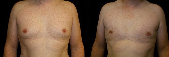 Gynecomastia Patient 13 Before & After