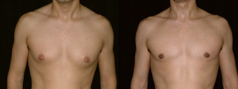 Gynecomastia Patient 3 Before & After