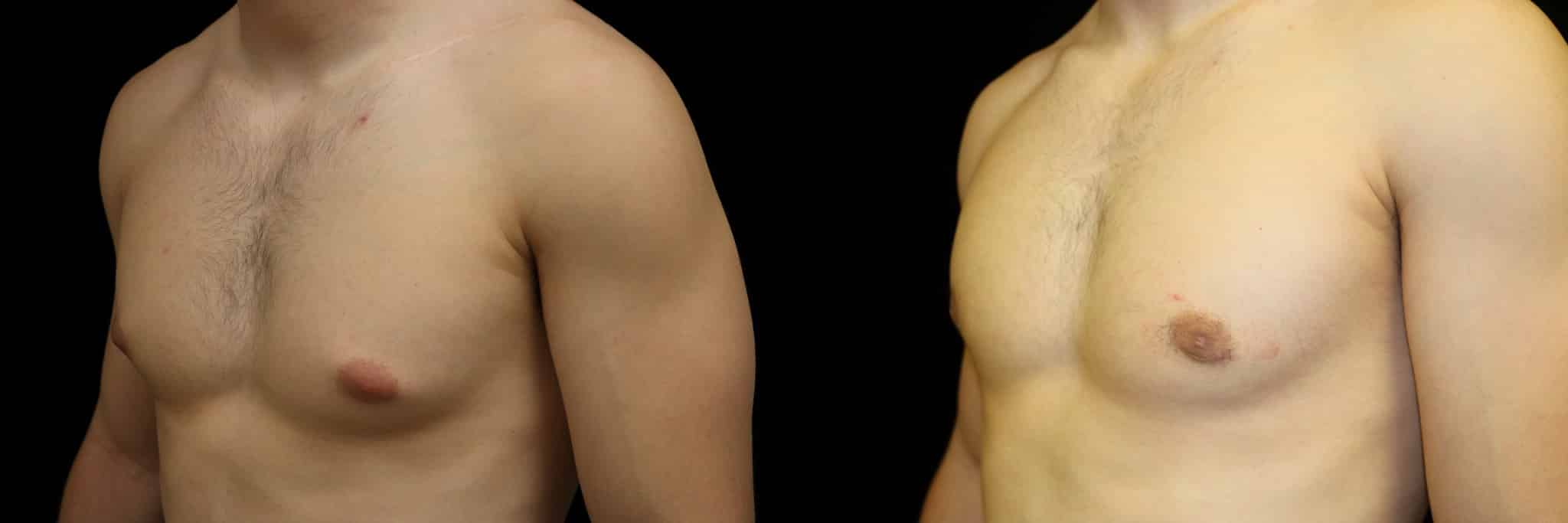 Gynecomastia Patient 16 Before & After Details