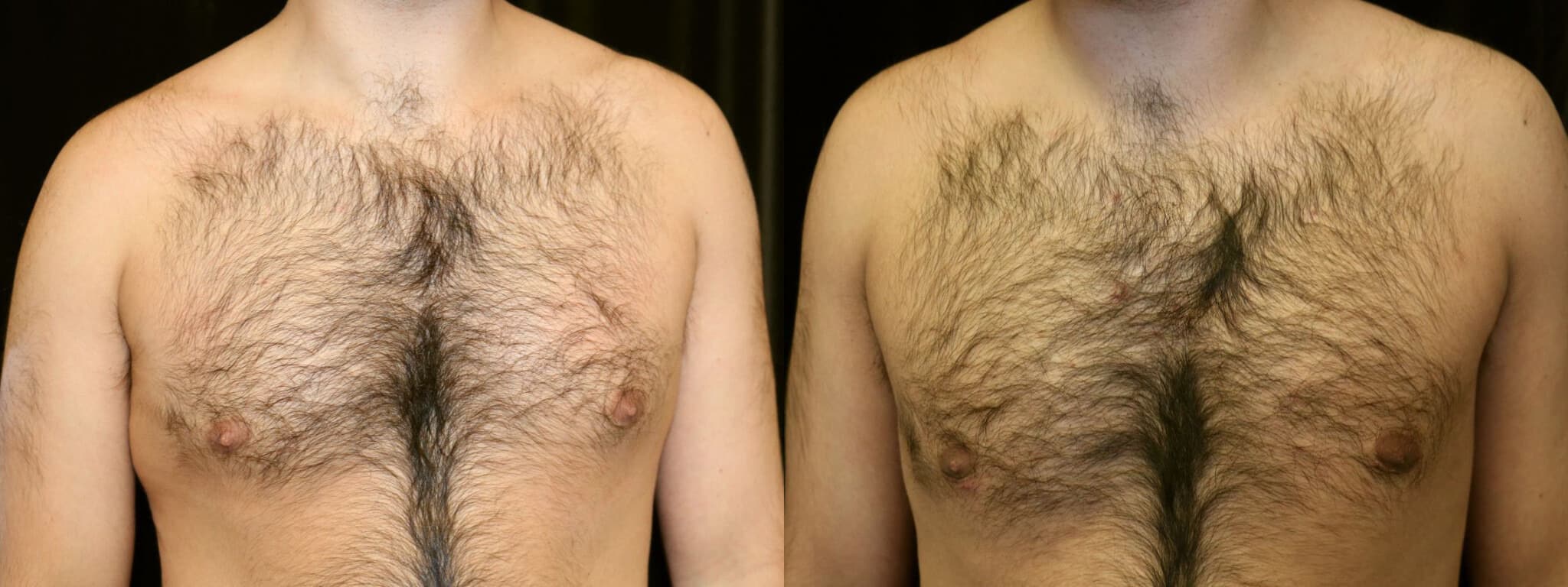 Gynecomastia Patient 14 Before & After