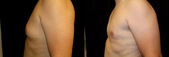 Gynecomastia Patient 13 Before & After Details