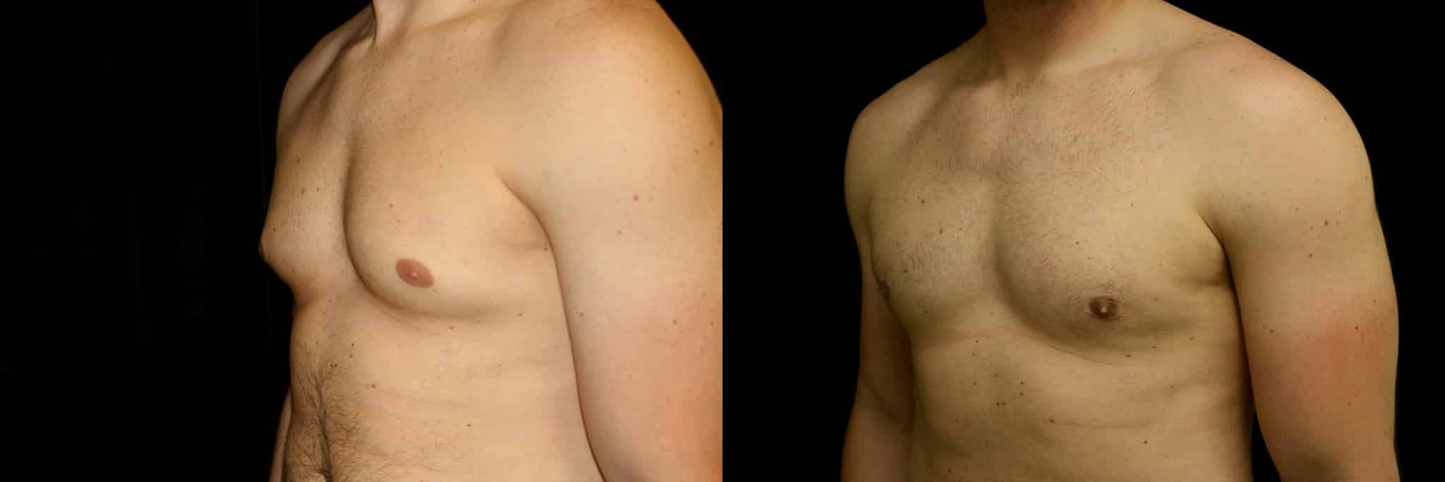 Gynecomastia Patient 8 Before & After Details