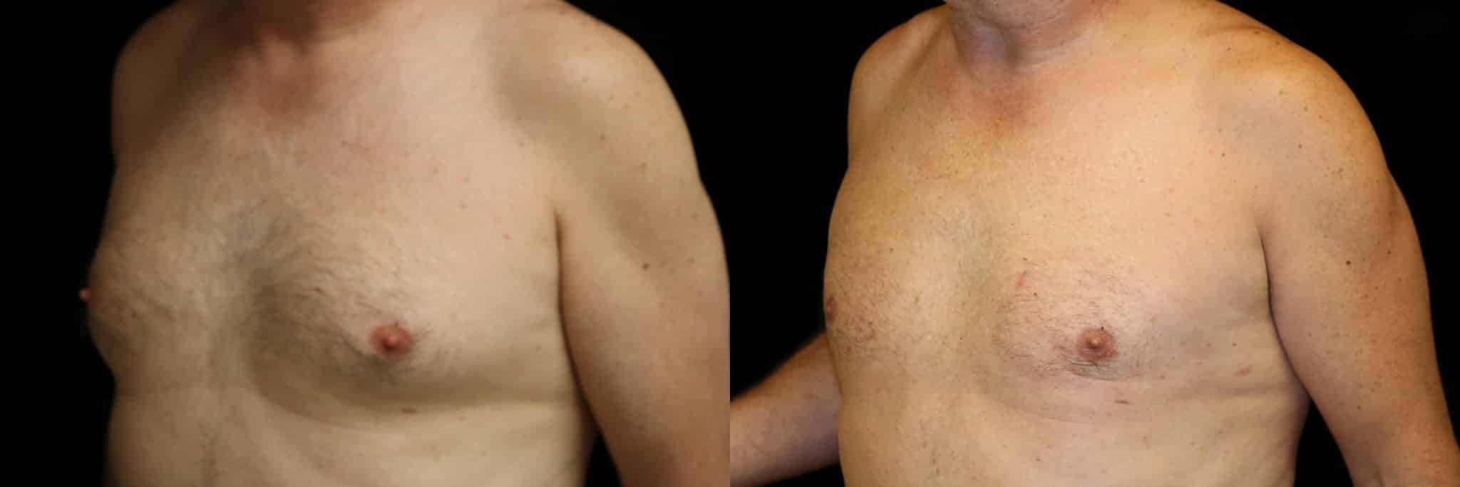 Gynecomastia Patient 15 Before & After Details