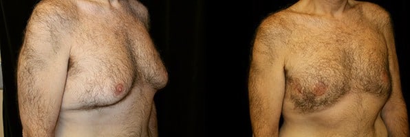 Gynecomastia Patient 19 Before & After Details