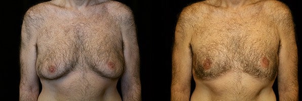 Gynecomastia Patient 19 Before & After