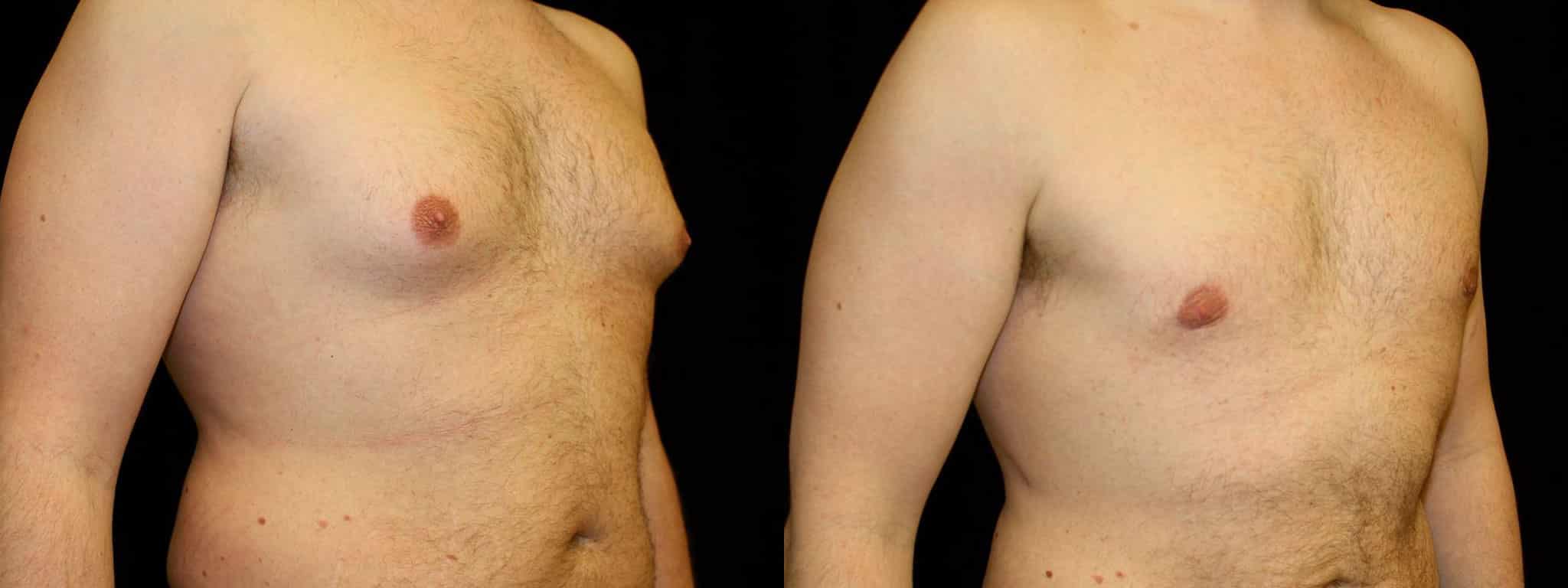 Gynecomastia Patient 16 Before & After Details