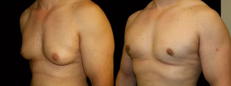 Gynecomastia Patient 6 Before & After Details