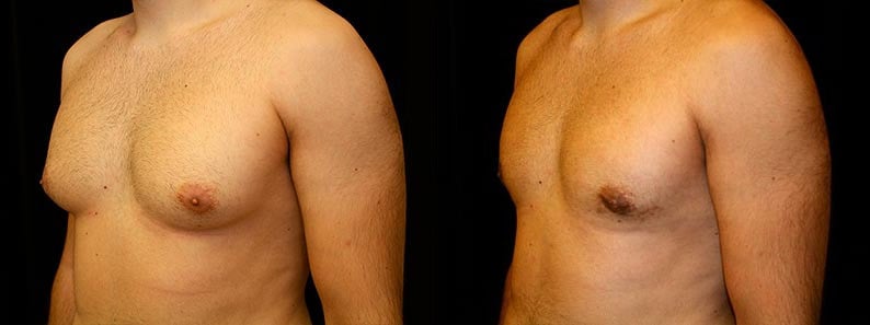 Gynecomastia Patient 7 Before & After Details