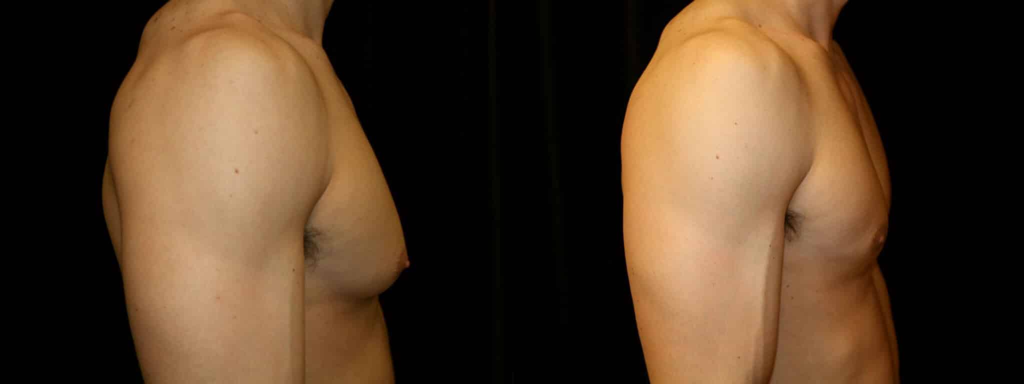 Gynecomastia Patient 20 Before & After Details