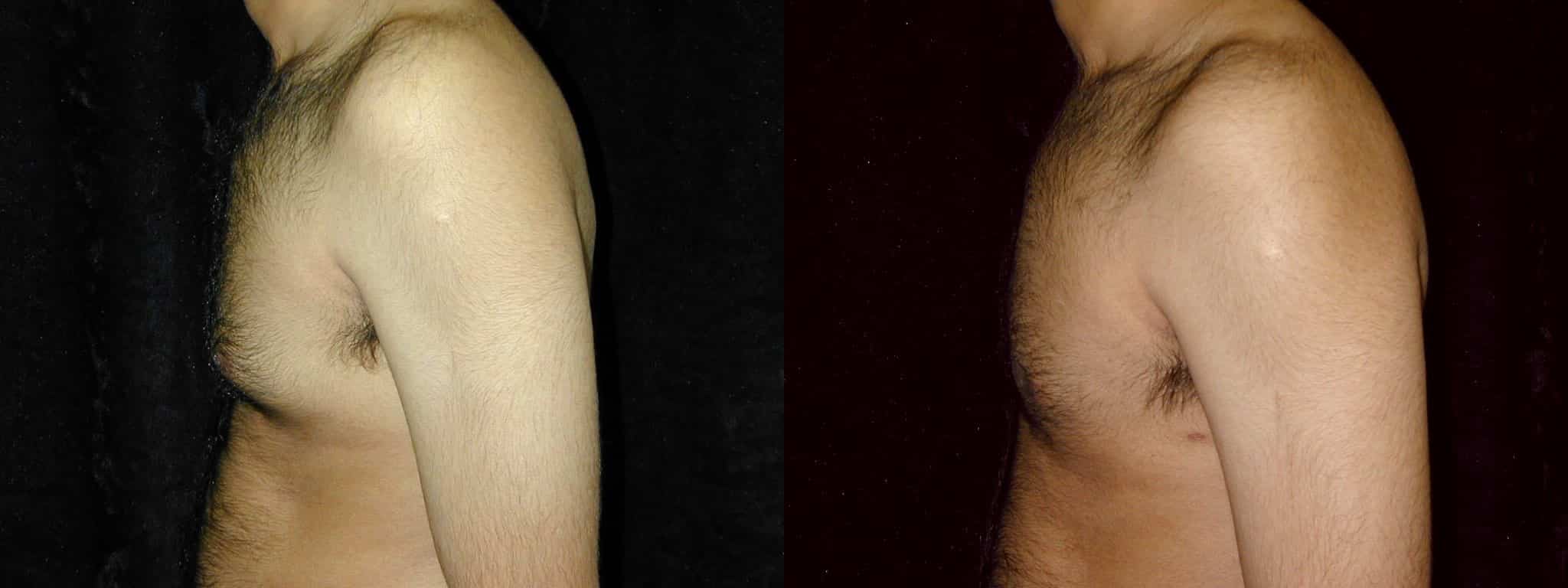 Gynecomastia Patient 10 Before & After Details