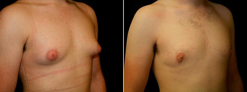 Gynecomastia Patient 11 Before & After Details