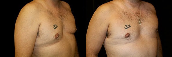 Gynecomastia Patient 12 Before & After Details