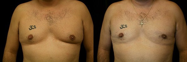 Gynecomastia Patient 12 Before & After