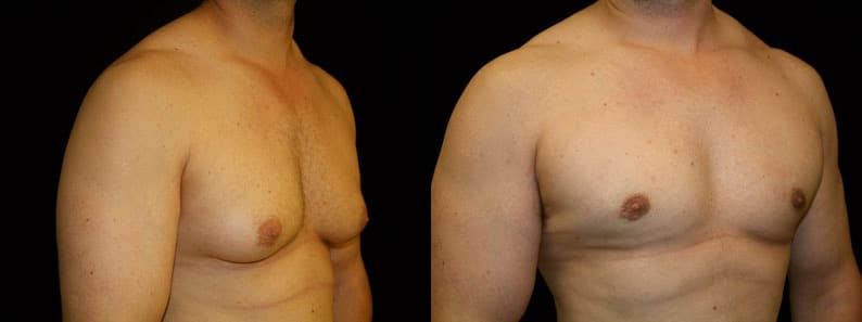 Gynecomastia Patient 6 Before & After Details