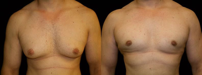 Gynecomastia Patient 6 Before & After