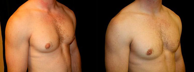 Gynecomastia Patient 9 Before & After Details