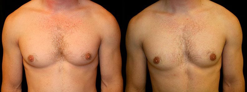 Gynecomastia Patient 9 Before & After