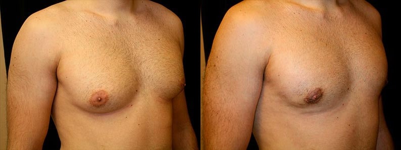 Gynecomastia Patient 7 Before & After Details