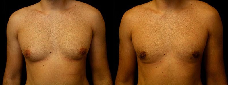 Gynecomastia Patient 7 Before & After